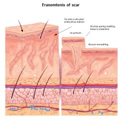 Illustration Showing Different Types of Indented Atrophic Acne Scars Below Skin Surface
